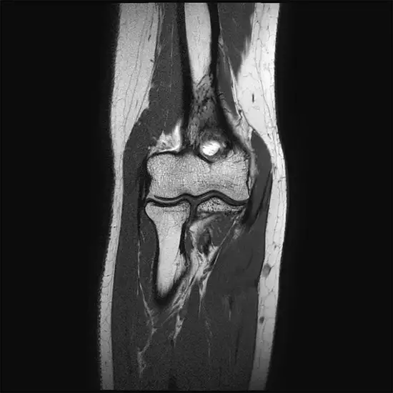 MRI Screening Arm With Elbow